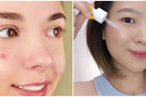 Manfaat serum Somethinc untuk jerawat, ini 5 jenis yang bisa kamu coba