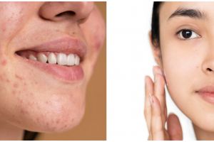 8 Manfaat acne serum Somethinc, basmi jerawat membandel