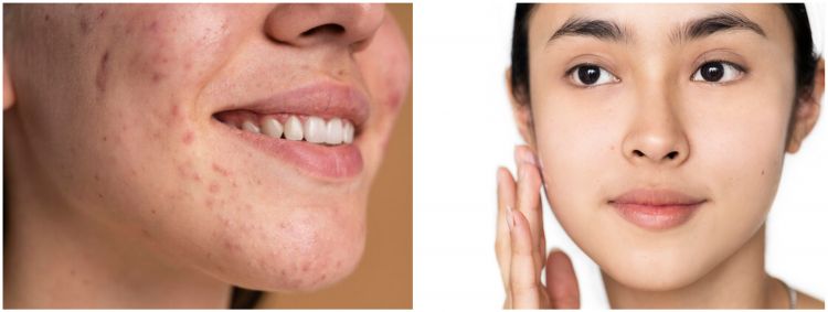 8 Manfaat acne serum Somethinc, basmi jerawat membandel