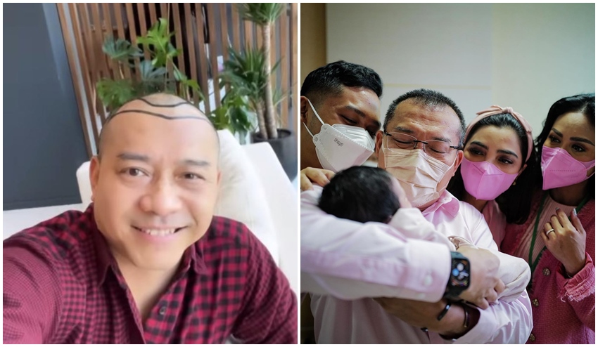 9 Potret Anang Hermansyah sebelum dan sesudah transplantasi rambut