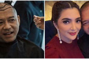 9 Potret Anang Hermansyah sebelum dan sesudah transplantasi rambut