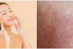 5 Cara menghilangkan urat di wajah, kulit kembali mulus