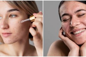 8 Manfaat Azarine Acne Serum, basmi tuntas jerawat di wajah