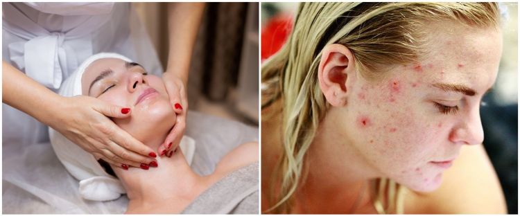 7 Perawatan atasi beruntusan di wajah, pakai chemical peeling