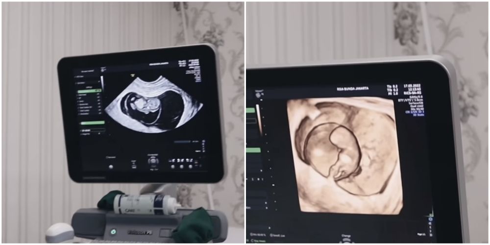 Curhat Jonas Rivanno saat Asmirandah keguguran usai positif Covid-19