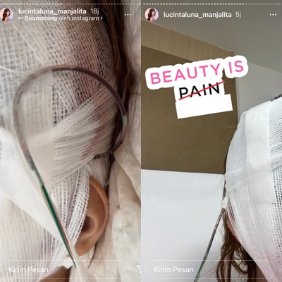Momen Lucinta Luna operasi wajah, potret terbarunya bikin penasaran