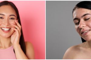7 Manfaat Serum Implora Acne, bantu kulit bebas jerawat