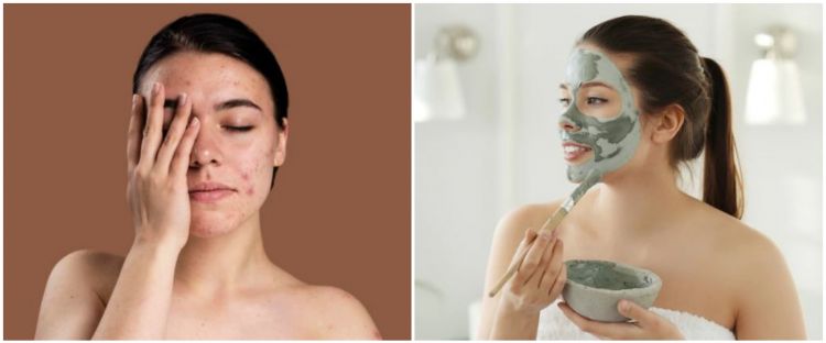 5 Cara mengatasi wajah mengelupas dan perih pakai masker alami
