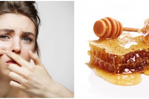 11 Cara menghilangkan bopeng di wajah, cara alami hingga teknologi