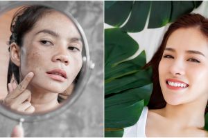 Kenali begini cara cegah dan menyamarkan hiperpigmentasi dalam 6 hari