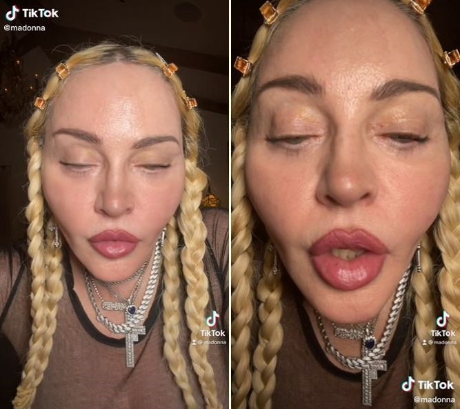 Viral potret wajah Madonna usai operasi plastik, bikin fans prihatin