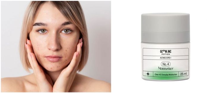 7 Skincare malam untuk kulit berjerawat, harga di bawah Rp 100 ribu