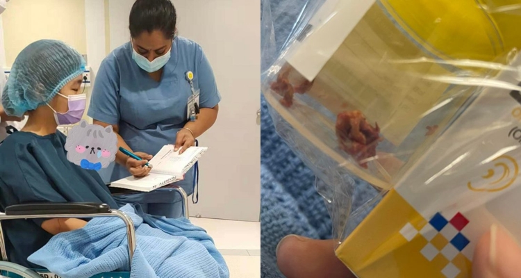 Bersihkan telinga dengan cotton buds, wanita ini harus jalani operasi