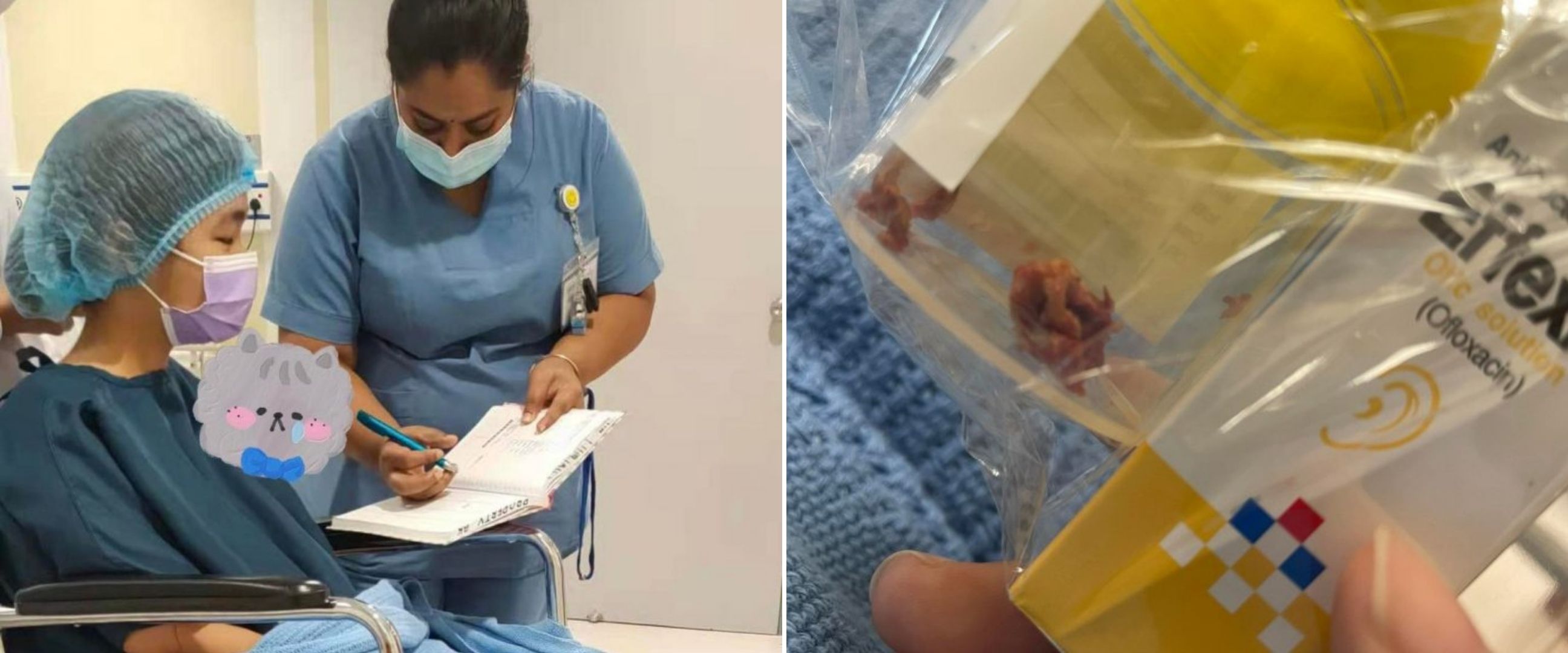 Bersihkan telinga dengan cotton buds, wanita ini harus jalani operasi