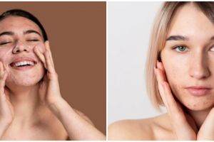4 Ciri-ciri wajah sedang detox, terjadi pengelupasan kulit
