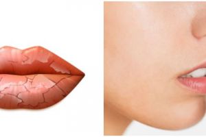 Penyebab bibir kering saat berpuasa dan 11 cara mengatasinya