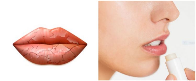 Penyebab bibir kering saat berpuasa dan 11 cara mengatasinya
