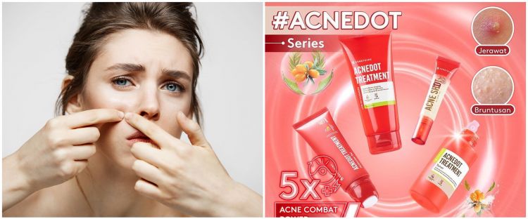 4 Produk skincare Somethinc untuk atasi jerawat di bawah Rp 100 ribu