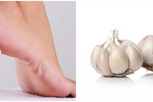 9 Cara menghilangkan kapalan di tangan dan kaki, gunakan bawang putih