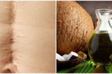 11 Cara menghilangkan bekas luka pada kulit pakai bahan alami