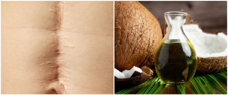 11 Cara menghilangkan bekas luka pada kulit pakai bahan alami