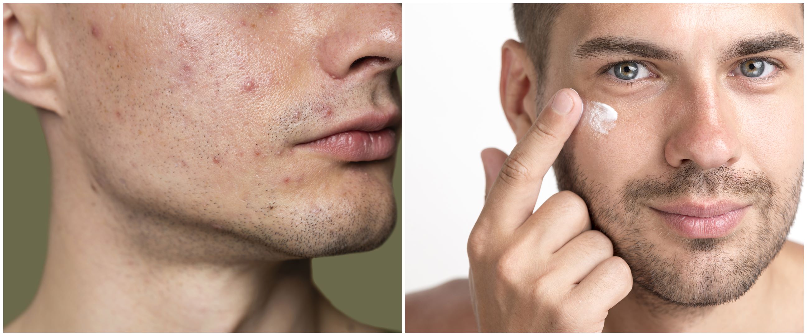 11 Skincare laki-laki atasi wajah berjerawat, di bawah Rp 200 ribu