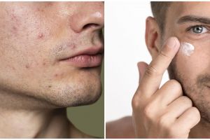 11 Skincare laki-laki atasi wajah berjerawat, di bawah Rp 200 ribu