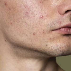 11 Skincare laki-laki atasi wajah berjerawat, di bawah Rp 200 ribu