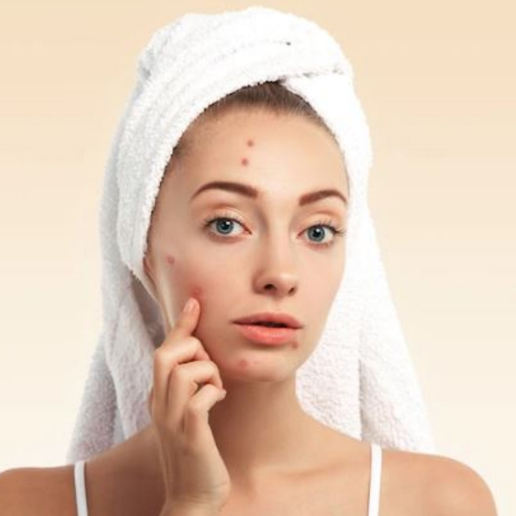 11 Rekomendasi acne patch untuk atasi jerawat di bawah Rp 120 ribu