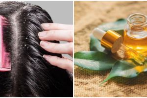 9 Cara mengatasi kulit kepala kering dan mengelupas pakai bahan alami