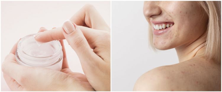 10 Rekomendasi skincare atasi jerawat punggung, di bawah Rp 150 ribu
