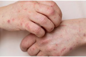 10 Makanan bisa atasi kulit terkena eksim, ampuh tanpa efek samping