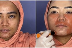 Transformasi makeup barbie look wanita berjerawat, hasil bikin takjub