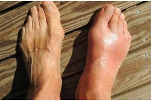 Cara membuat minuman herbal untuk bantu turunkan asam urat