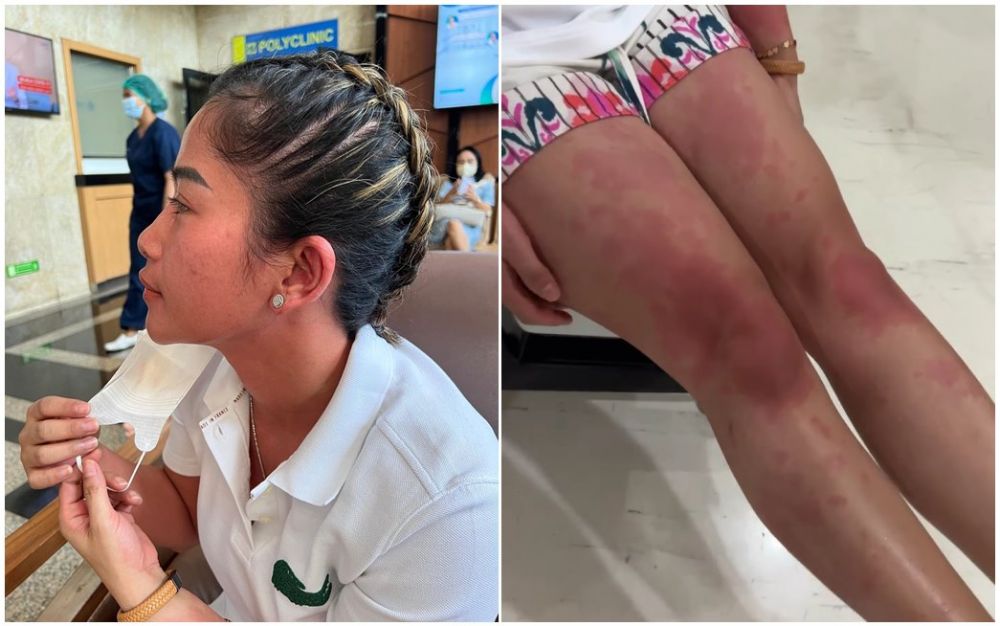 Farida Nurhan keracunan makanan, badan merah hingga diopname