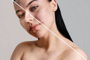 Yuk ketahui "Peta Jerawat" pada wajah dan penyebabnya