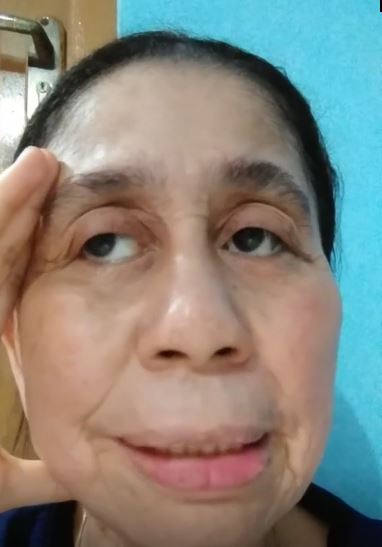 Disangka editan punya wajah mirip nenek-nenek, wanita 28 tahun ini ternyata mengidap penyakit langka