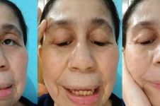 Disangka editan punya wajah mirip nenek-nenek, wanita 28 tahun ini ternyata mengidap penyakit langka