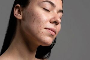 Cuma pakai 2 bahan dapur, begini cara atasi breakout biar wajah jadi tenang