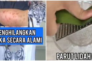 Hanya pakai 2 bahan alami, tips menghilangkan bekas luka ini bikin kulit kembali mulus