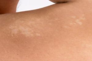 Hanya pakai 2 bahan dapur, cara menghilangkan panu ini bikin kulit kembali mulus