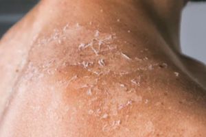 Cara mengatasi kulit bersisik agar halus dan lembut kembali pakai 3 bahan alami