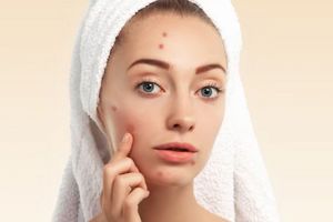 Jangan sampai salah, ini 6 cara memilih kandungan acne spot treatment sesuai jenis jerawat