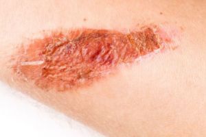 Hanya butuh 2 bahan dapur, begini cara menyamarkan bekas koreng pada kaki agar mulus kembali