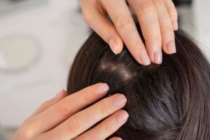 Hanya pakai 2 bahan dapur, ini cara menghilangkan kutu dan telurnya agar rambut bebas gatal