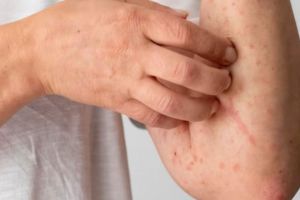 Hanya pakai 3 bahan dapur, begini cara atasi biduran secara alami agar tidak gatal dan membekas