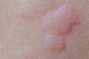 Dijamin ampuh, begini 7 cara mengatasi biduran menggunakan bahan alami