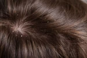 Rambut bersih optimal, begini trik menghilangkan ketombe pada pria pakai 1 bahan dapur