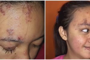 Wajah pengantin kena cacar api jelang nikah ini dirias MUA pakai Paes Solo, hasilnya tuai pujian