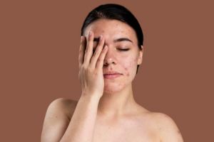 7 Cara mengatasi skin barrier yang rusak, hindari terlalu sering lakukan eksfoliasi